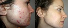 1-chemicky-peeling