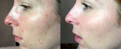 2-chemicky-peeling-Brno