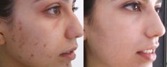 4-chemicky-peeling-hloubkovy